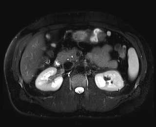 Soubor:Mr 3t abdomen.jpg