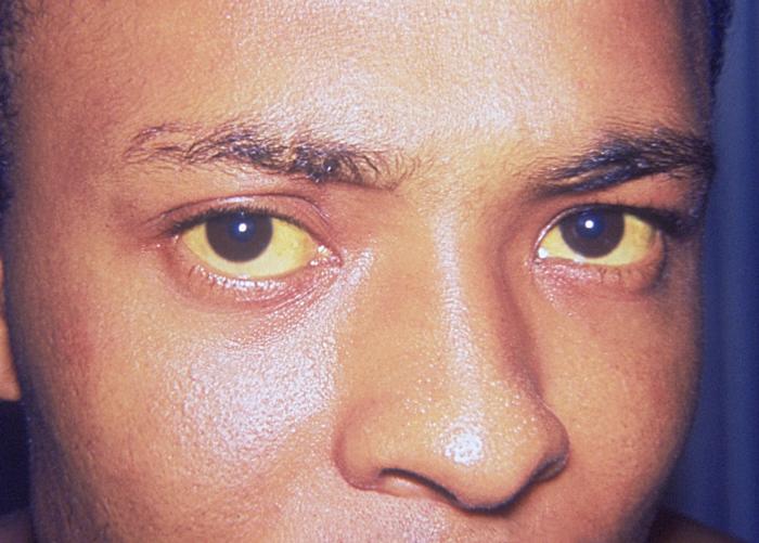 Soubor:Jaundice eye.jpg